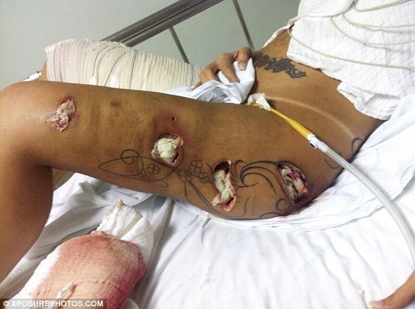 The 27-year-old suffered from septic shock after wounds from a procedure last July became infected