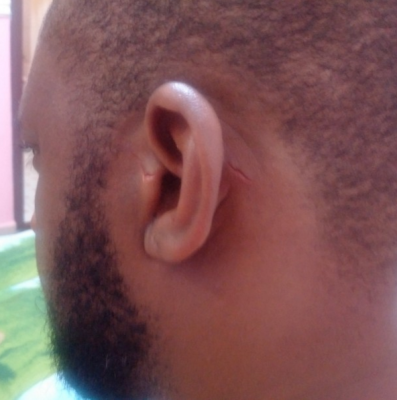 Yul's bruised ear as he crashed through a door while escaping from the bandits