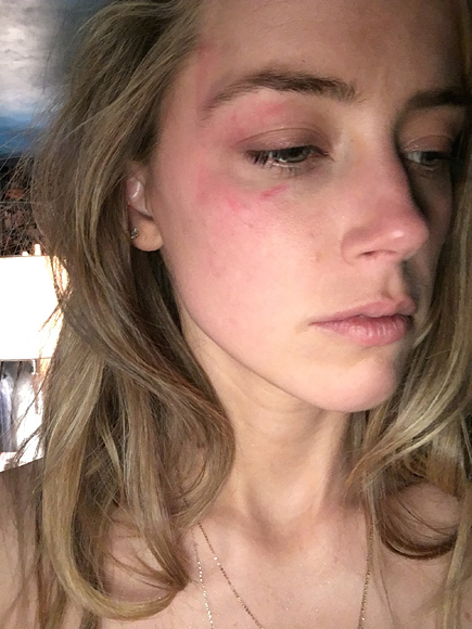 Amber's evidence of alleged assault shows the actress with what appears to be a bruise on her right eye. Photo:PEOPLE