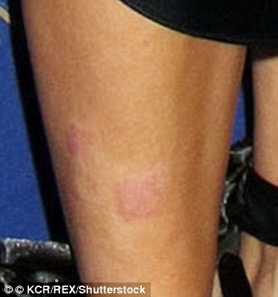 A close-up look of a rash on her leg at a recent event