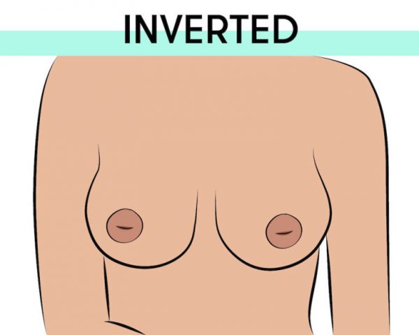 inverted nipples