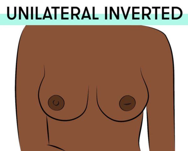 unilateral inverted nipples