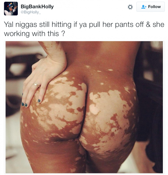 Vitiligo